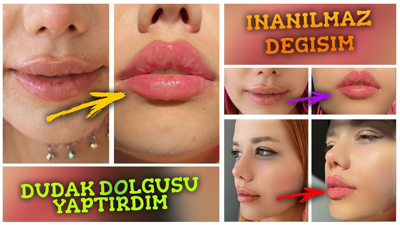 DUDAK DOLGUSU! “Çok Değiştim”
