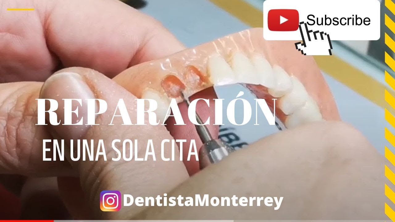 Reparación de Prótesis Dental 👅 Paso a Paso en 1CITA