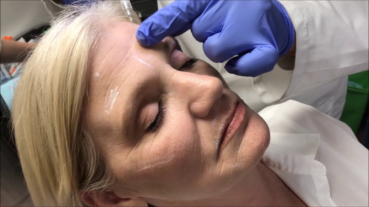 Forehead Structural Filler