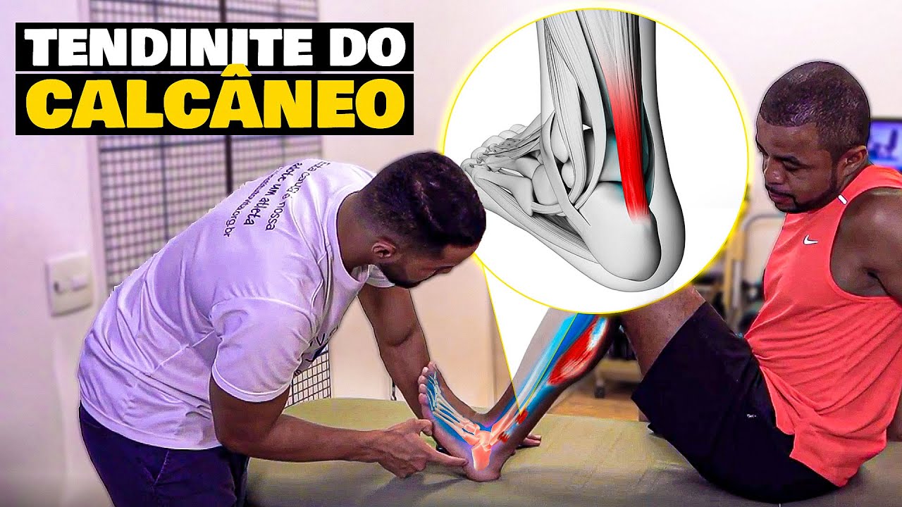 LESÃO NO TENDÃO DE AQUILES: COMO PREVENIR E CUIDAR?