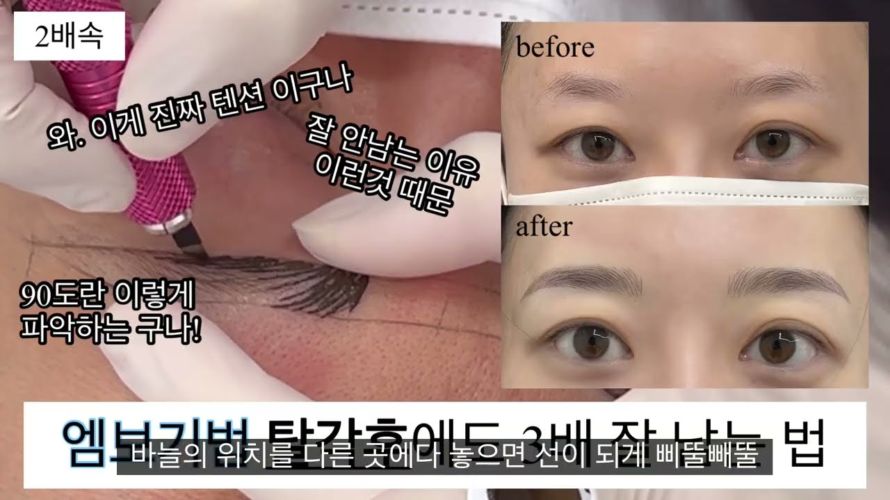 [엠보,콤보기법 시술풀영상]미쳤다 생각하고 모든정보 꿀팁 오픈.탈각후 보장