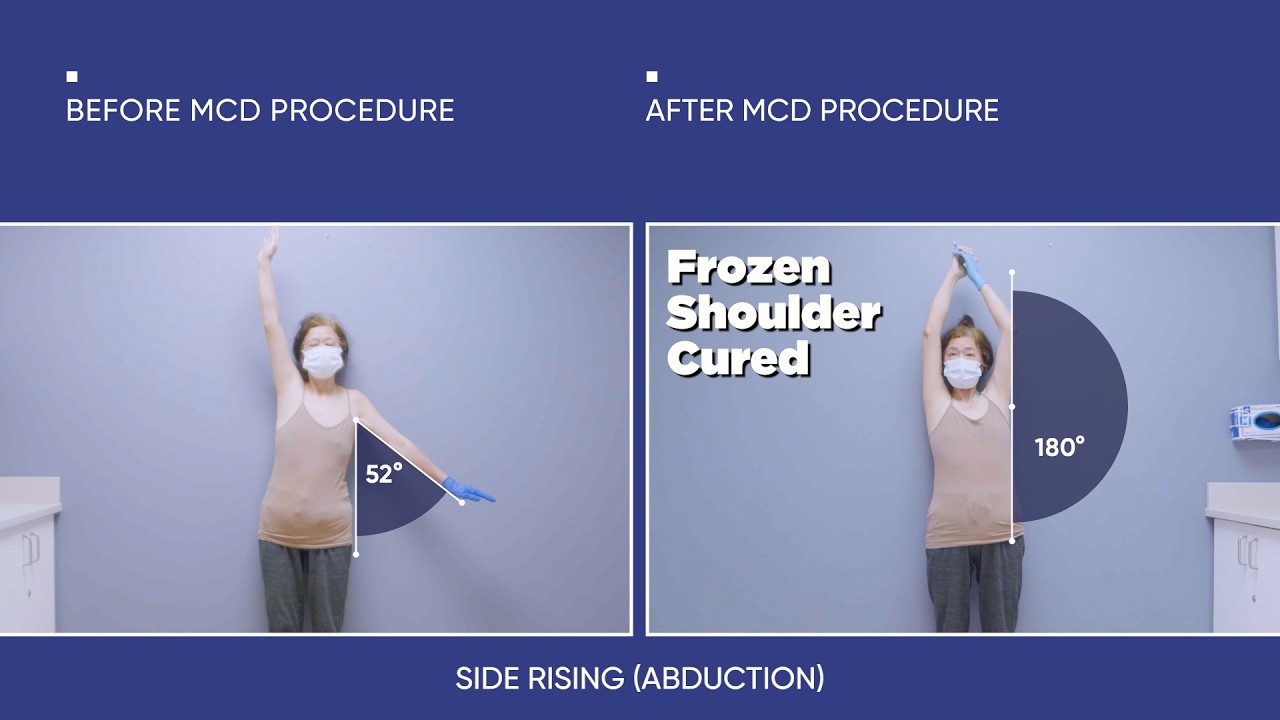 Frozen Shoulder After an Injury — Len’s 2-Day Recovery Story