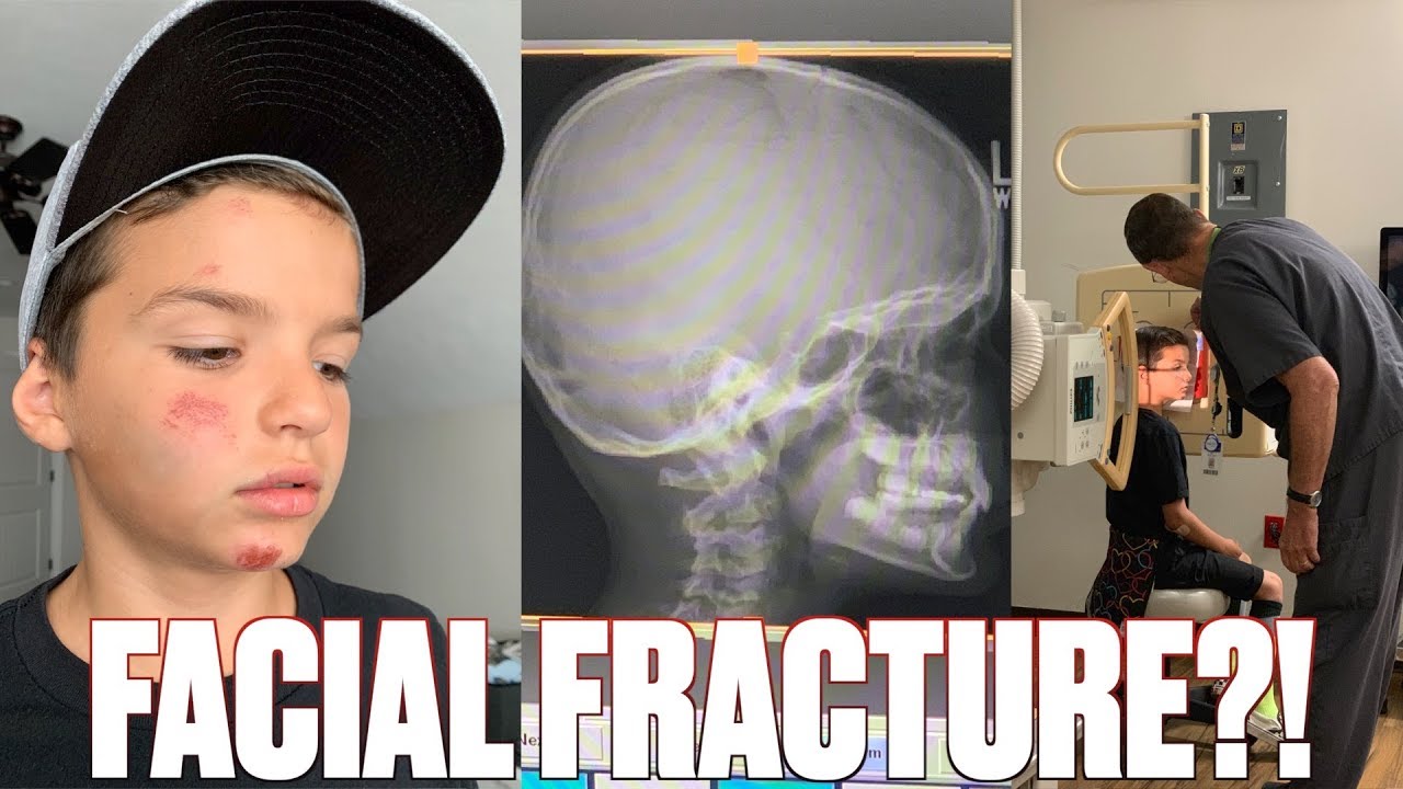 GETTING X-RAYED FOR A FACIAL FRACTURE | DID HE SERIOUSLY BREAK A BONE IN HIS FACE?!