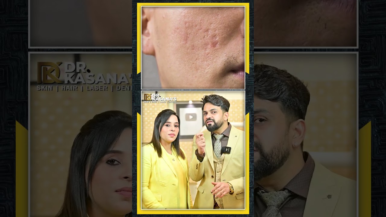 Acne Scars का इलाज कैसे होता है- Acne Scar Treatment Fractional CO2 Laser with  Subcision, MnRF