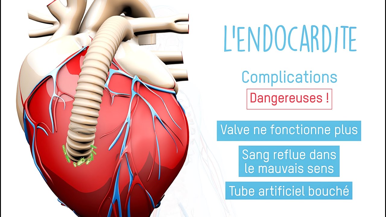 L'endocardite, ça s'évite !