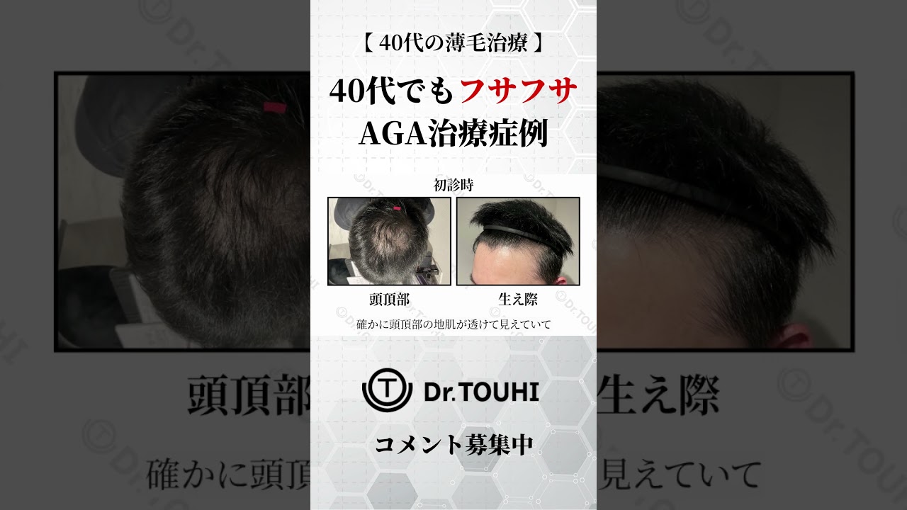 【薄毛治療】40代でもフサフサに！AGA治療症例のリアルをご紹介！