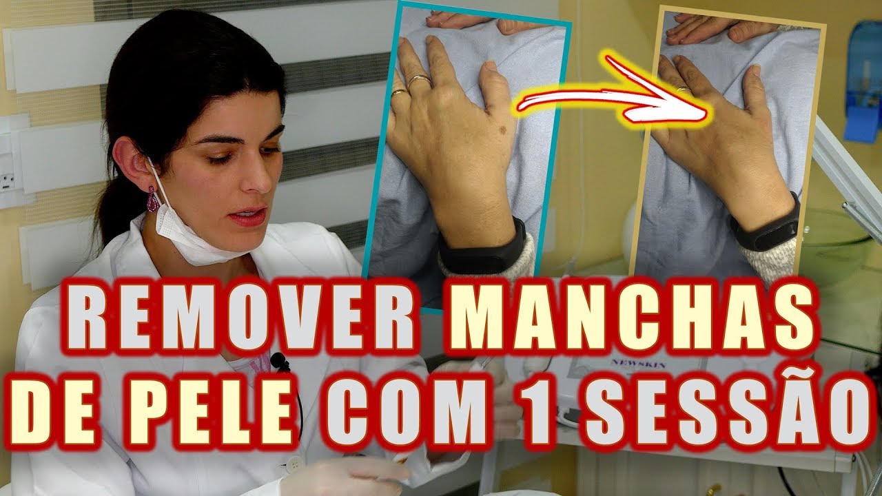 ELETROCAUTÉRIO x JATO de PLASMA - Clareando Manchas com o New Skin