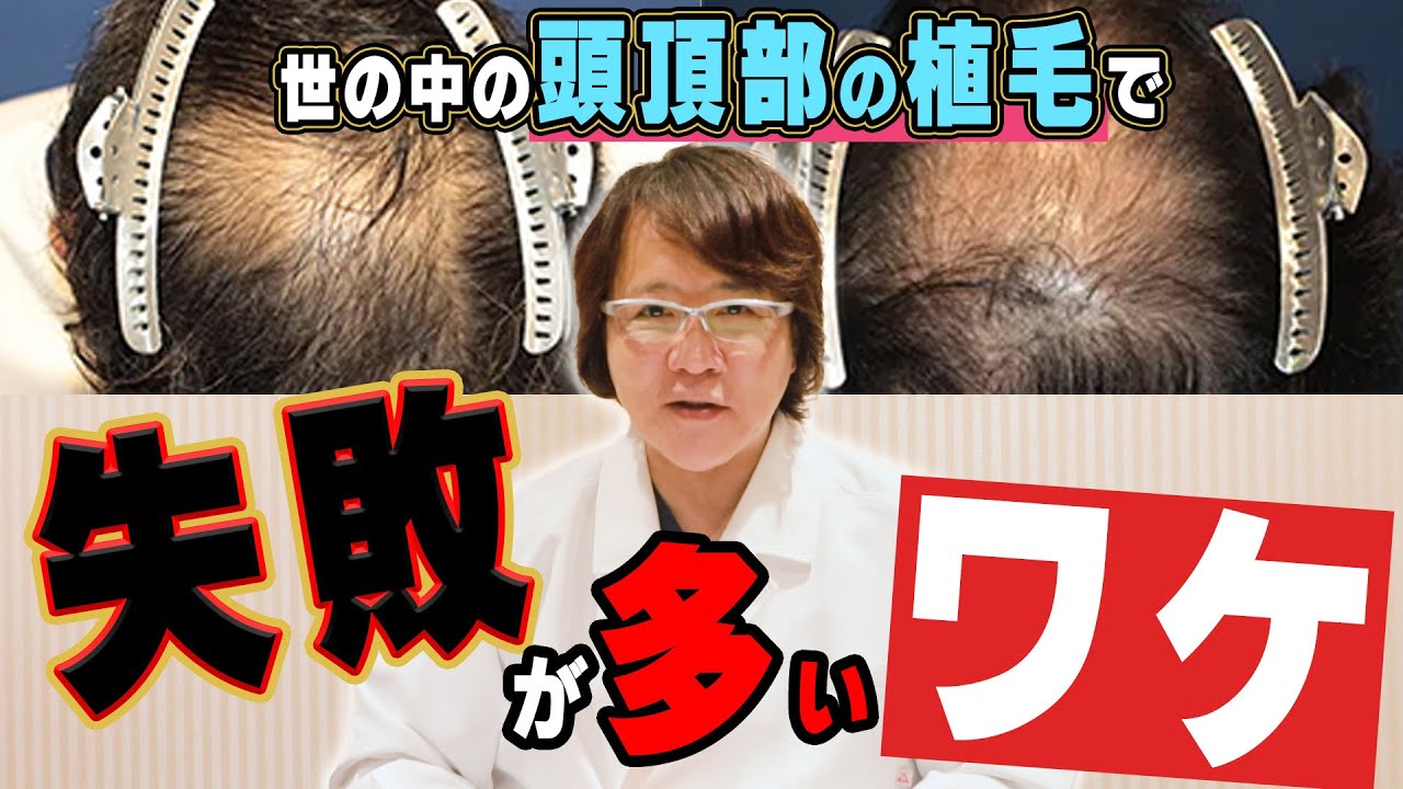【自毛植毛】頭頂部の植毛は難しい？専門医が解説！【薄毛】【植毛】