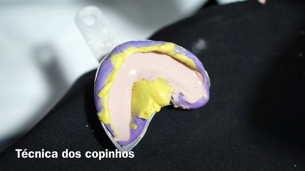 Vazamento de gesso - Técnica dos copinhos