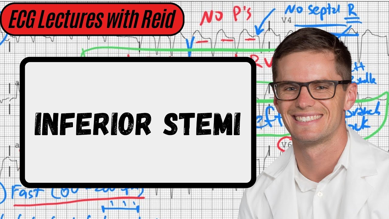 Inferior STEMI | Day 24 ECG Challenge