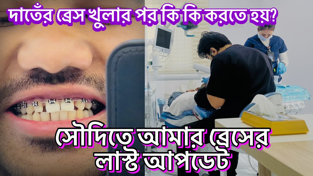 সৌদিআরব থেকে আমার দাঁতে ব্রেস লাগাতে কত টাকা খরচ হয়ছে?ব্রেস খুলার পর কতদিন রিটেইনার ব্যবহার করতে হয় 