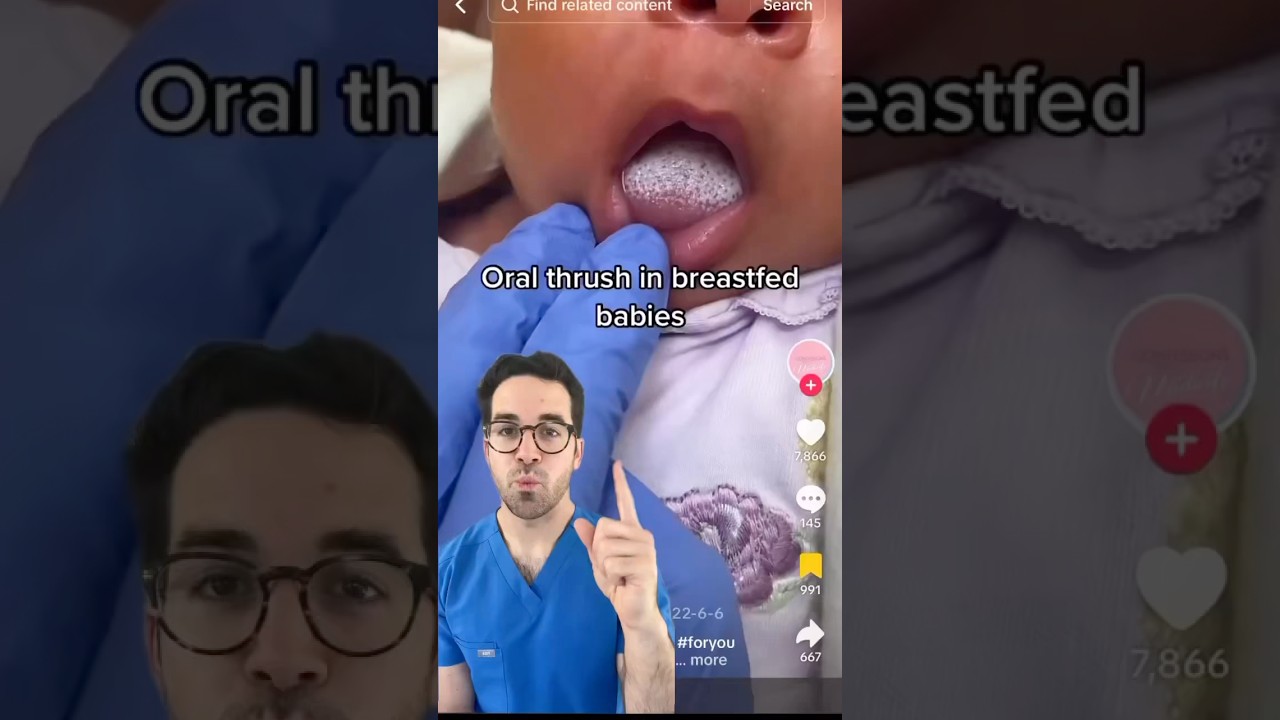 What Is Oral Thrush & How To Treat It | Dr. Yoshi Explains Baby Mouth Infections