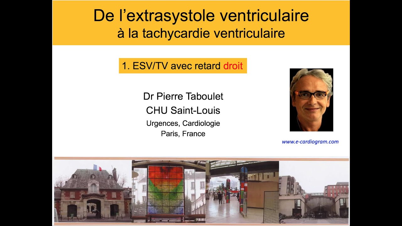 10a. De l'ESV à la tachycardie ventriculaire. Retard droit. P Taboulet