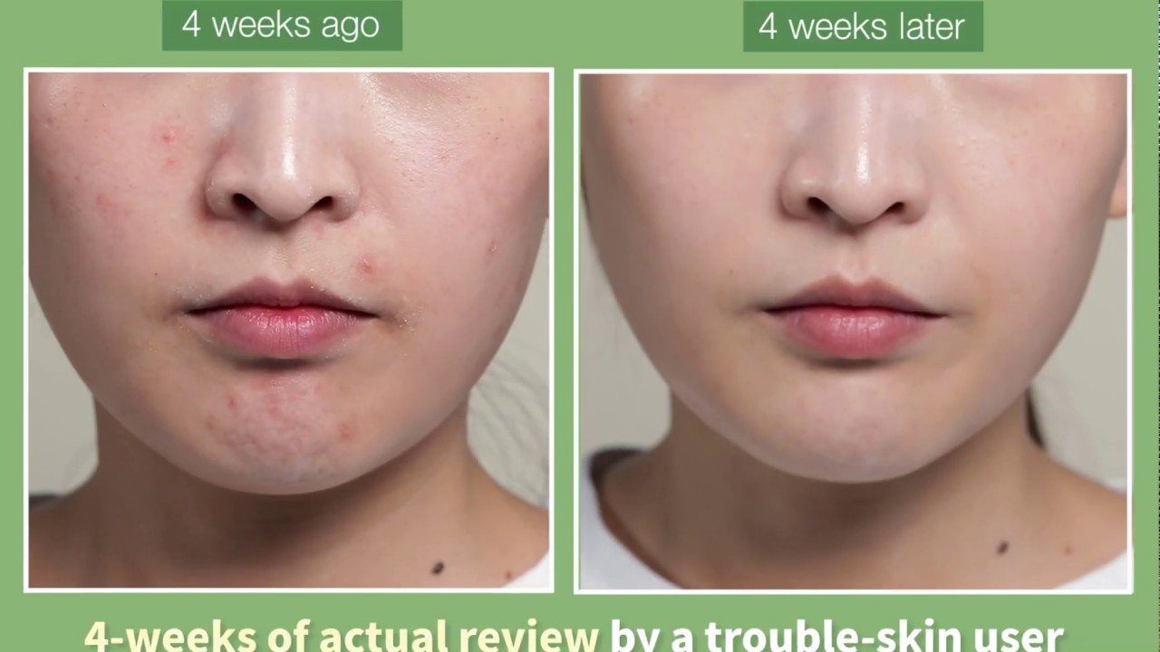 Somebymi Miracle Serum 4 weeks review B & A 💧 (eng)
