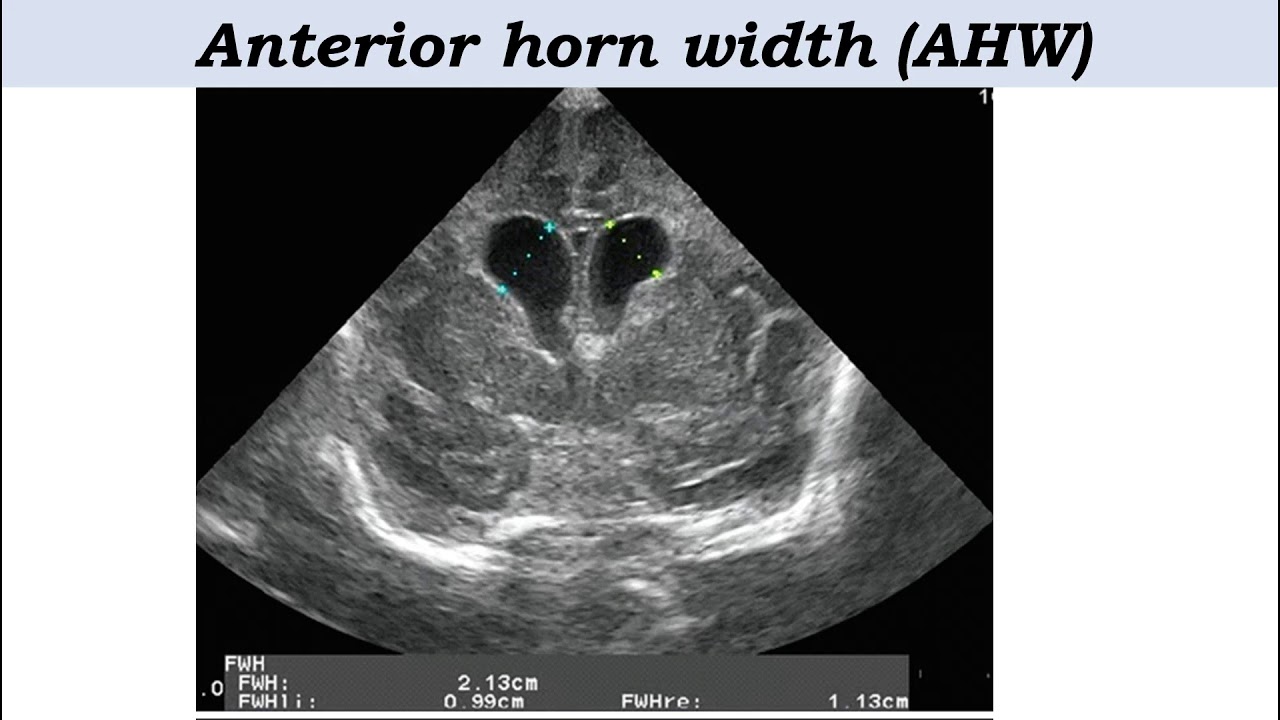 Radiology case (10 ) :: Neonatal Germinal matrix hemorrhage .. cranial ultrasound Dr.Mohamed soliman