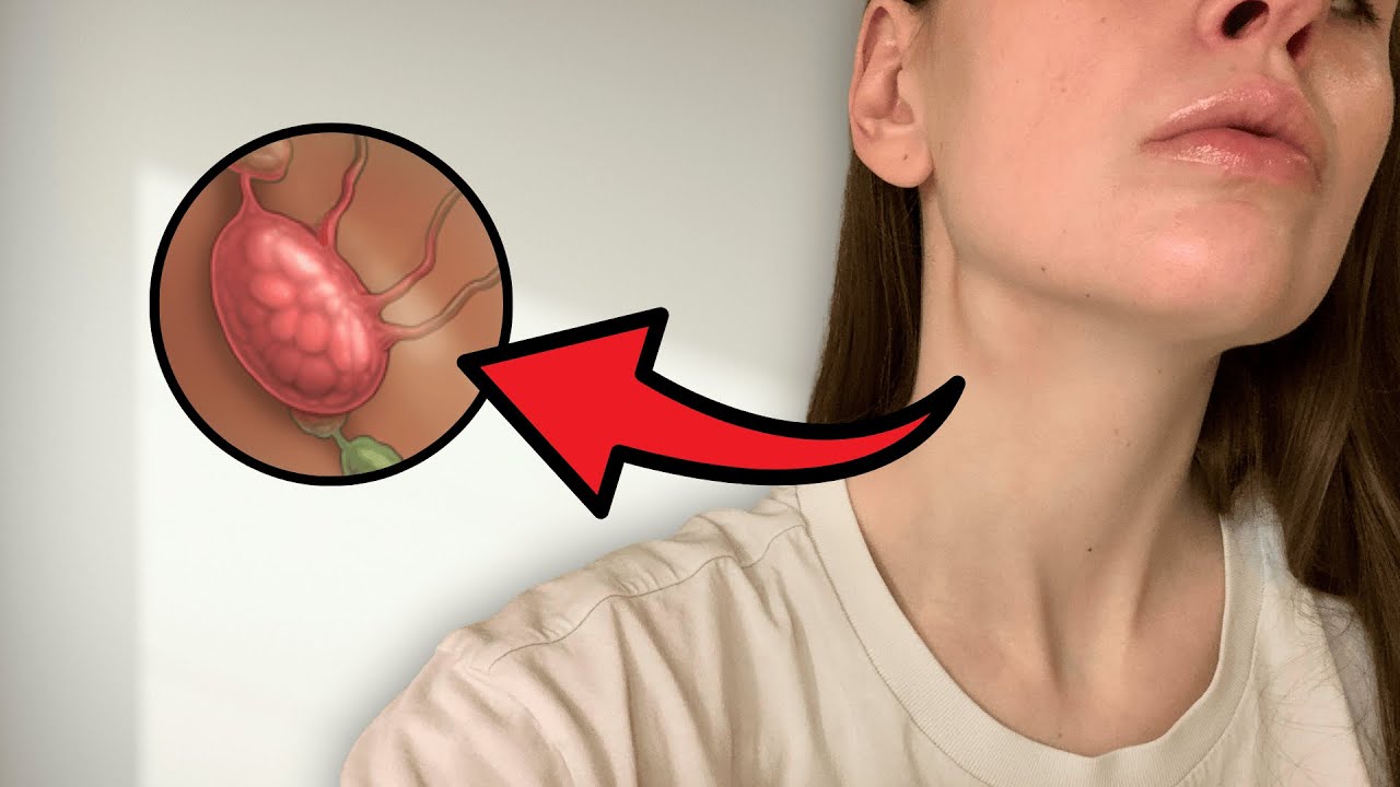 How I Found a Mass in My Neck | Surgery Update