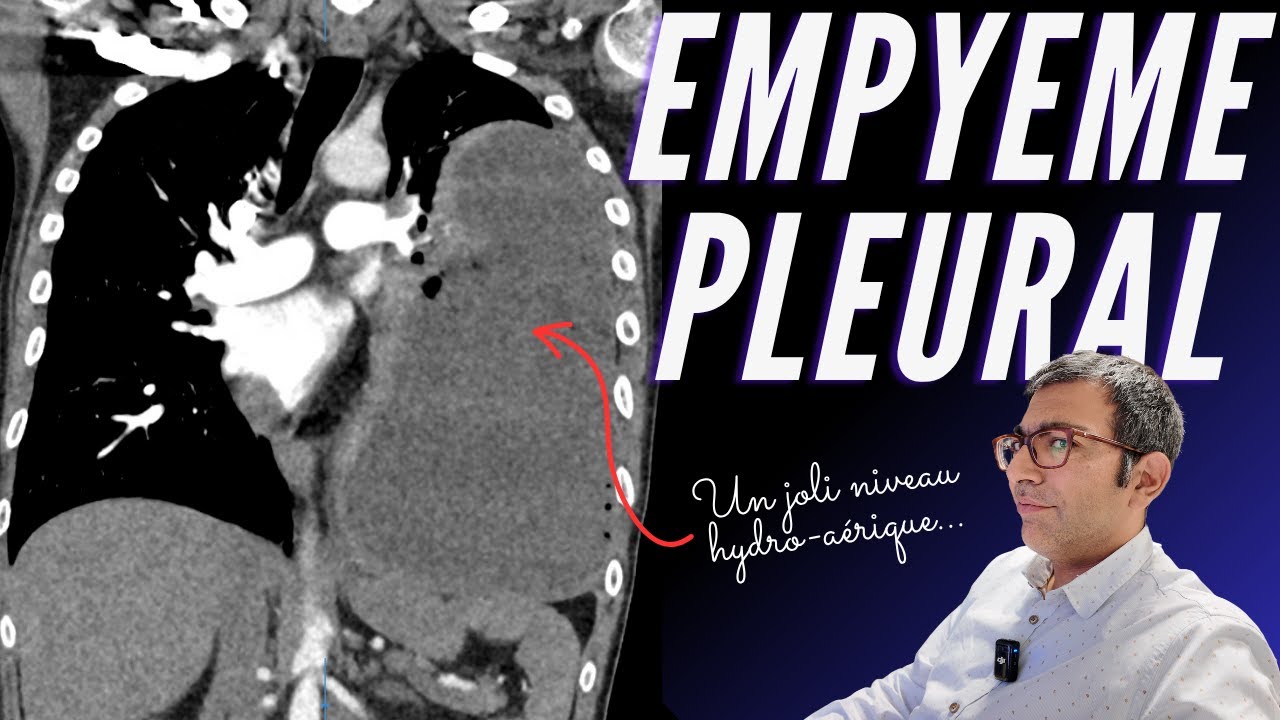 Empyème pleural : un cas impressionnant en scanner