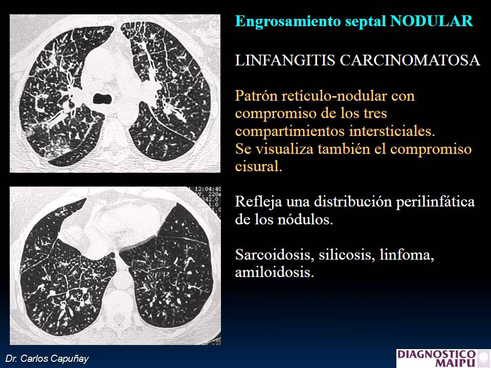 TCAR   Signos e InterpretaciÃ³n I FAARDIT 2014
