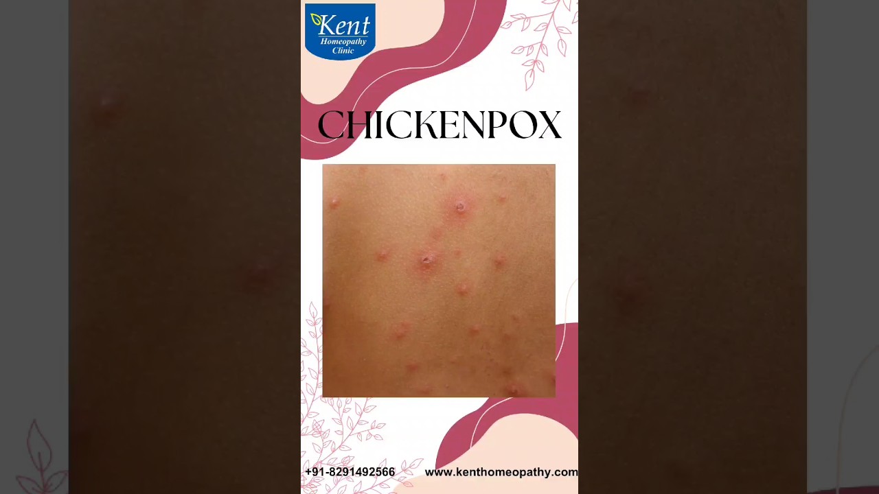 Chickenpox - Best homeopathy treatment Drkukreja kalani online consult8291492566