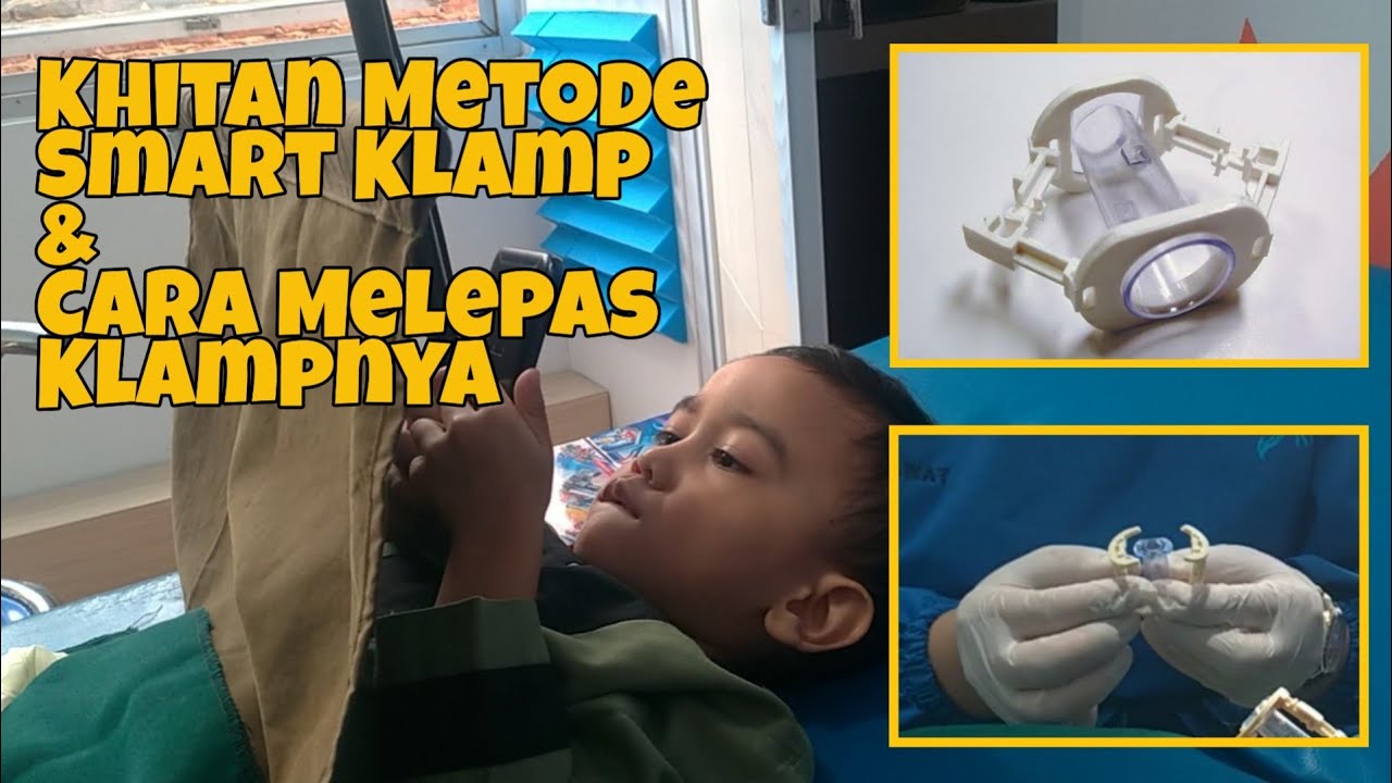 Khitan Metode Smart Klamp Ga Sakit? Langsung bisa beraktifitas | Khitanan Elfatih |