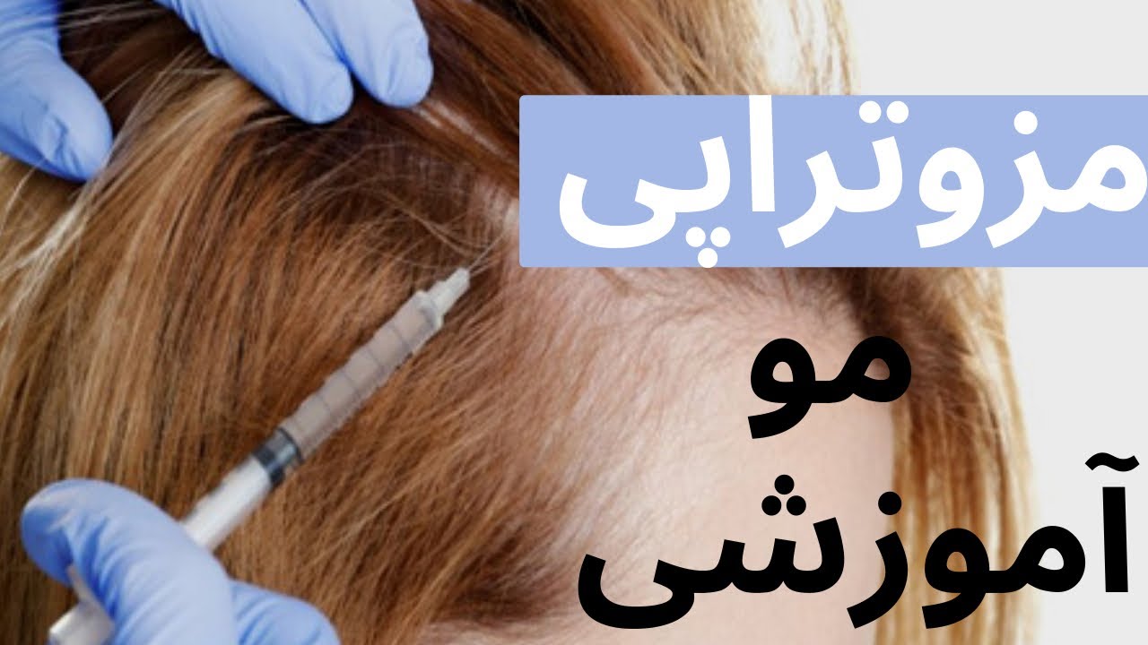 آموزش دقیق مزونیدلینگ مو🔻 تمام نکات کلیدی مزوتراپی🔻