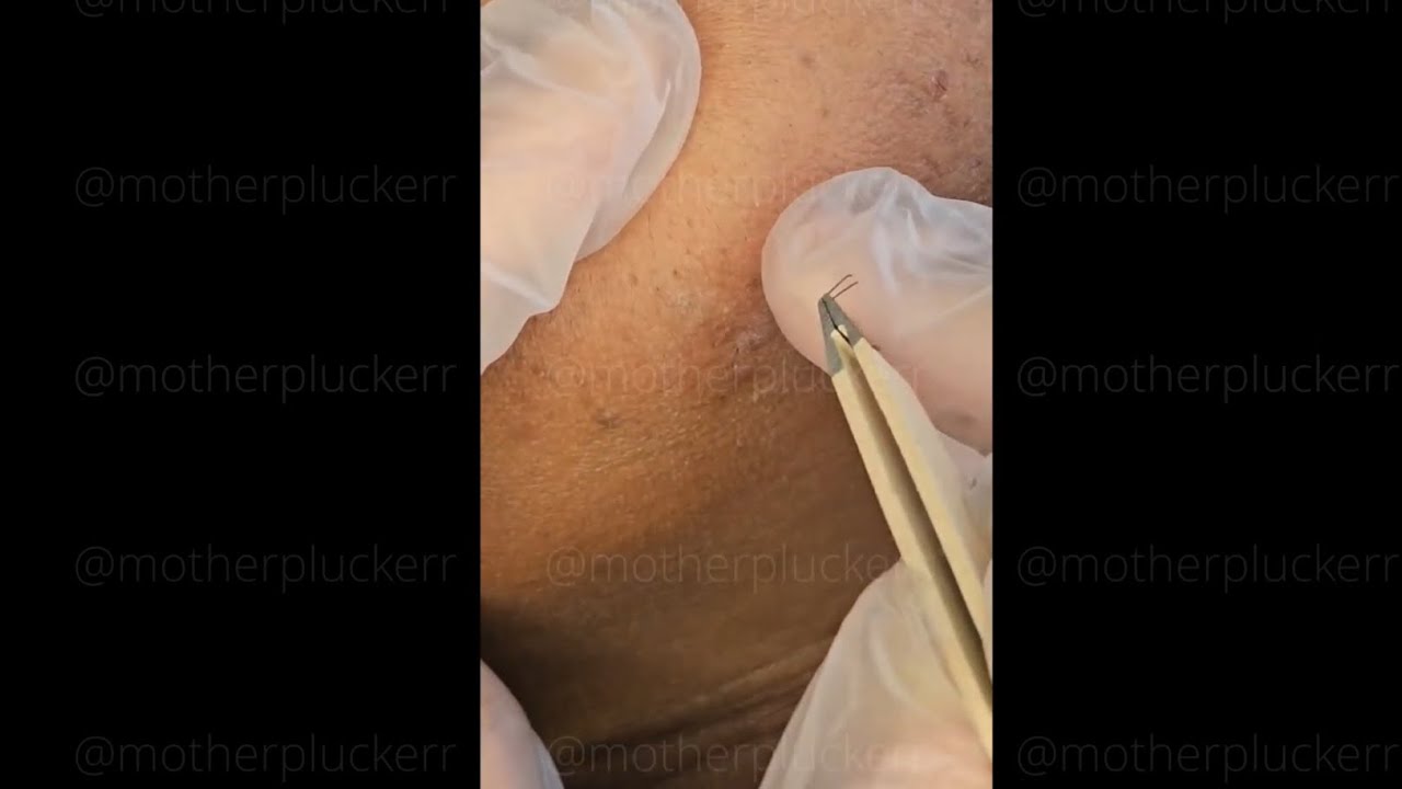 Hair Removal With Tweezers Ep. 1 