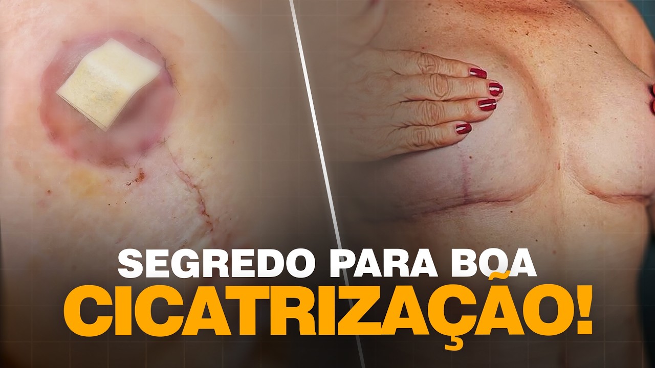 Cicatriz da Mastopexia: Verdades Que Ninguém Te Conta! | Cirurgia Plástica | Dr. Ícaro Samuel