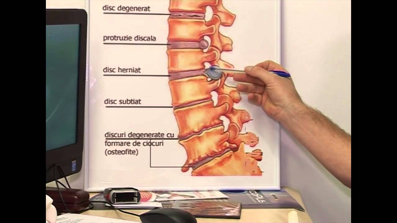 Cum apare hernia de disc? Traumatismele coloanei vertebrale.