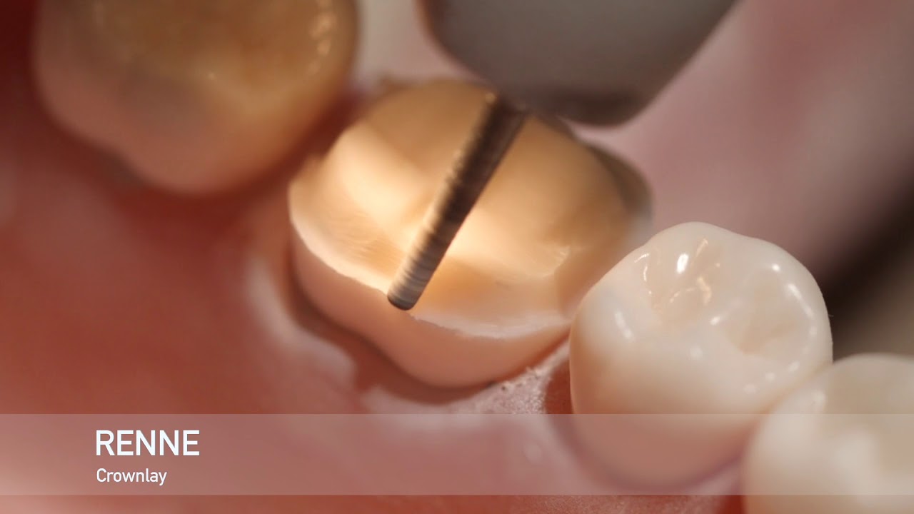 Ceramic Bonded Crownlay prep