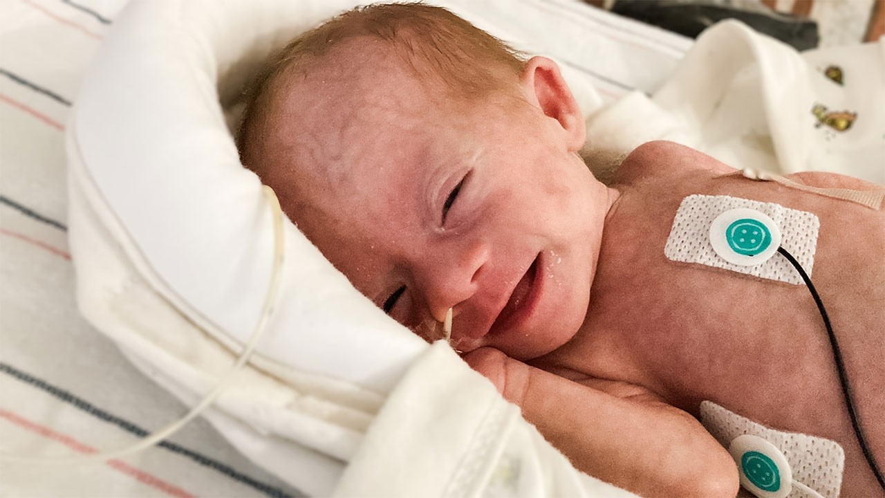 Родившись на 2 месяца раньше срока с синдромом Дауна, этот крошечный малыш вопреки всем прогнозам...