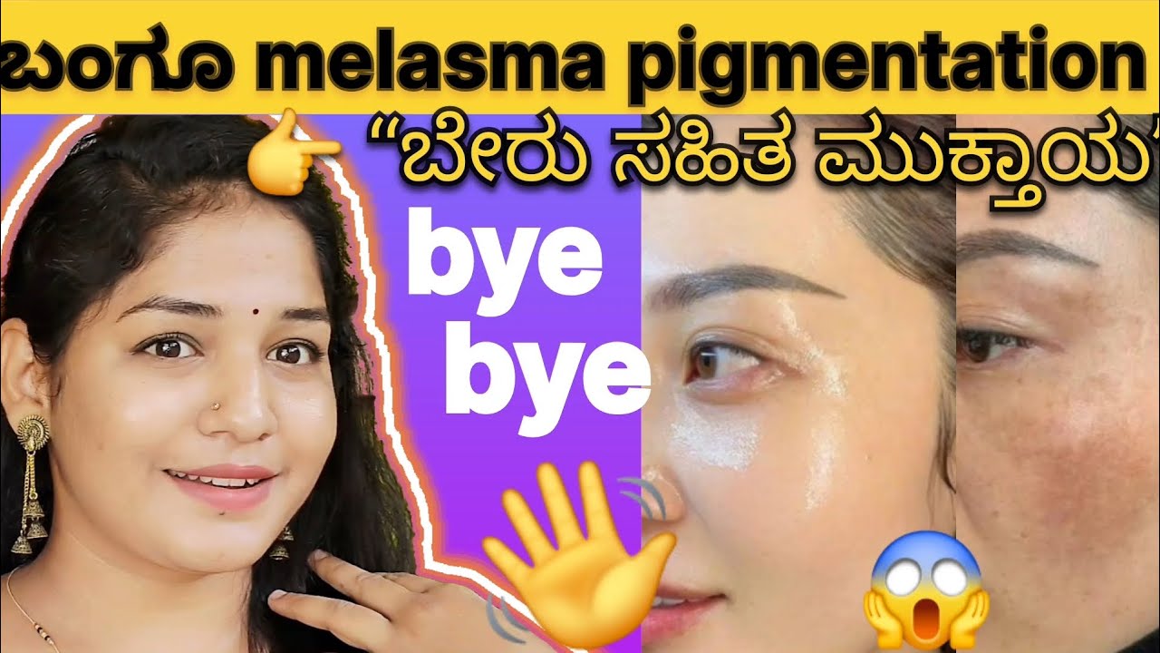 ಬಂಗೂ 😱 dark  ಸ್ಪಾಟ್ ಸಮಸ್ಯೆ? ಹೈಪರ್ ಪಿಗ್ಮೆಂಟೇಶನ್ ಪರಿಹಾರ ಮನೆಲ್ಲೇ 👉 “ಬೇರು ಸಹಿತ ಮುಕ್ತಾಯ”