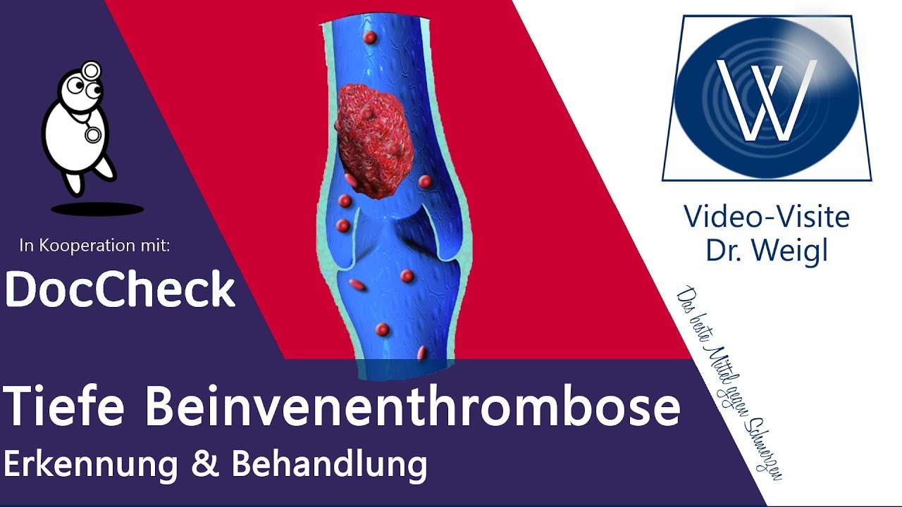 Tiefe Beinvenenthrombose (TVT): Die Gefahr des &Uuml;bersehens - Thrombose oder Muskelzerrung DocCheck #3
