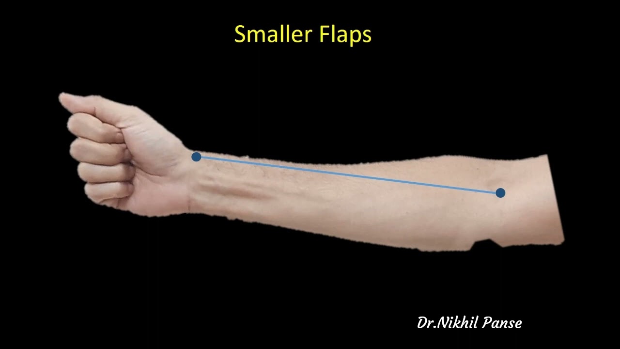 Radial artery forearm flap - Planning & Designing