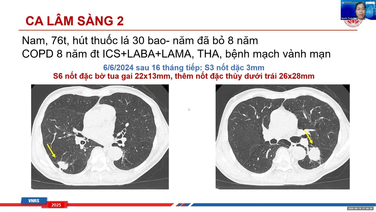 Hướng dẫn tiếp cận và quản lý nốt phổi