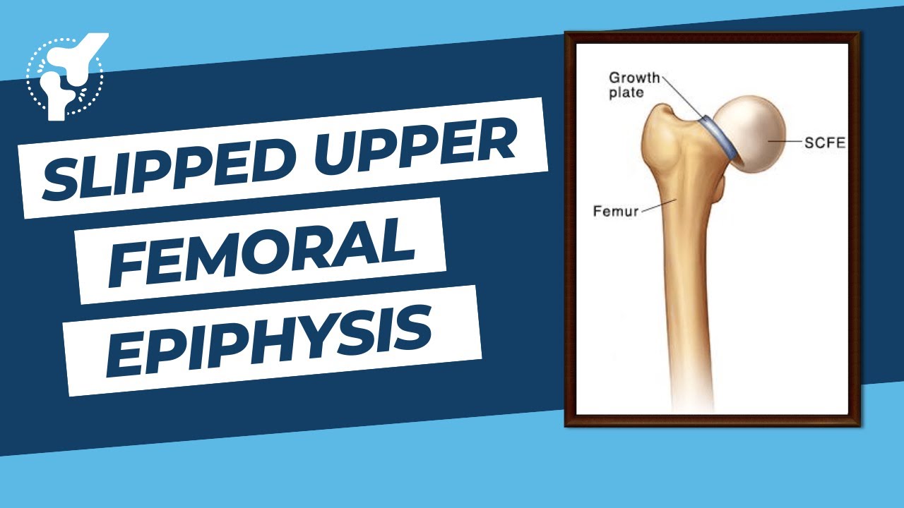 Slipped Upper Femoral Epiphysis | Orthopaedic Academy