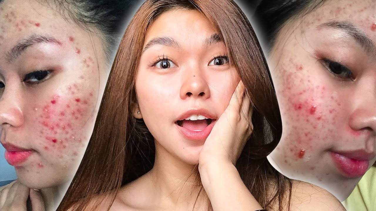 HOW I CLEARED MY SKIN | ACNE JOURNEY | Carla Marie (Vlog03)