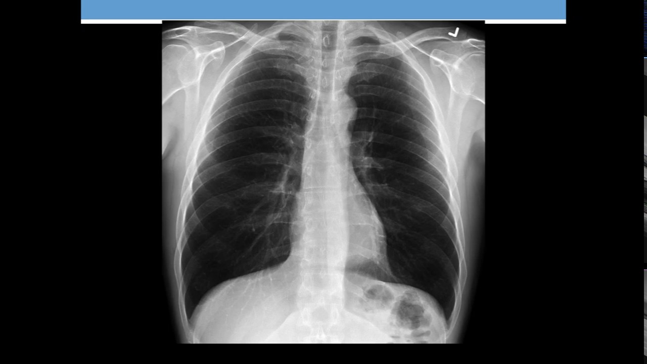 Dispnee cu radiografie toracica normala