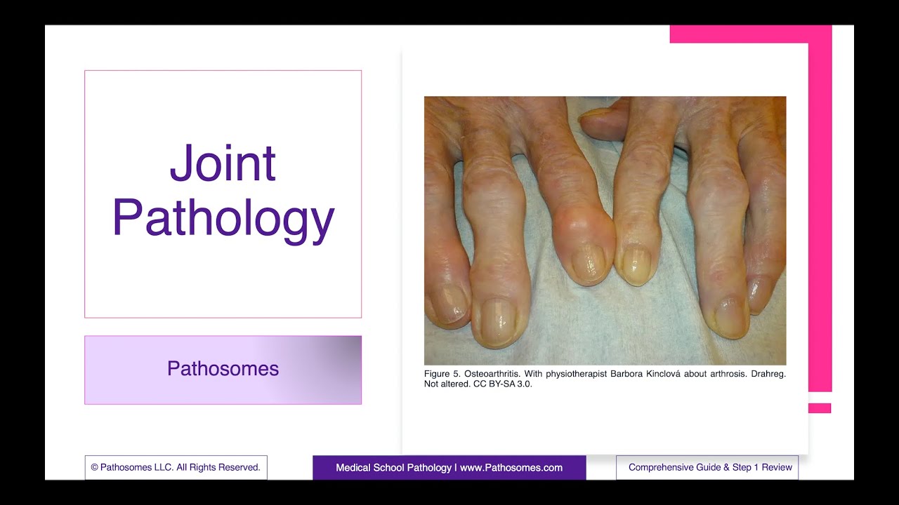 Joint Pathology | Comprehensive Guide & Step 1 Review | Pathology Step 1 USMLE