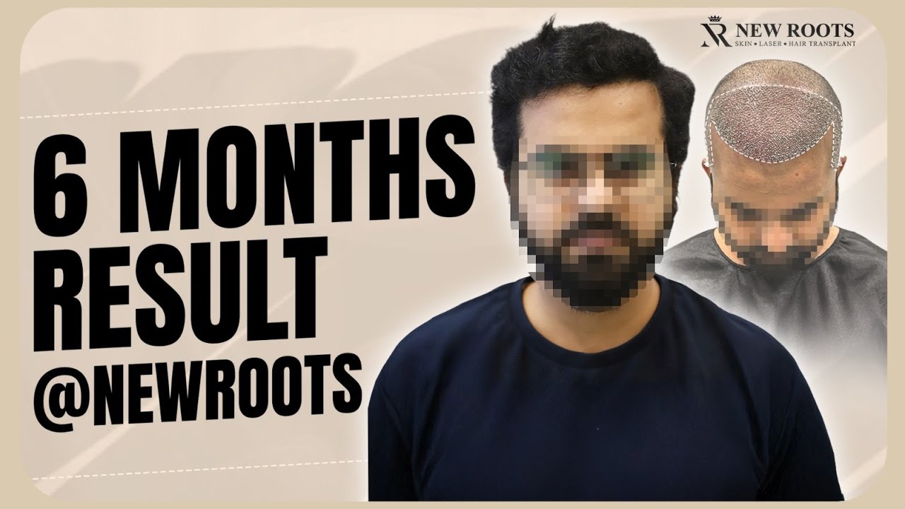 Hair Transplant in Lucknow - 6 Months Results | Cost of Hair Transplant in Lucknow | 3000 Grafts
