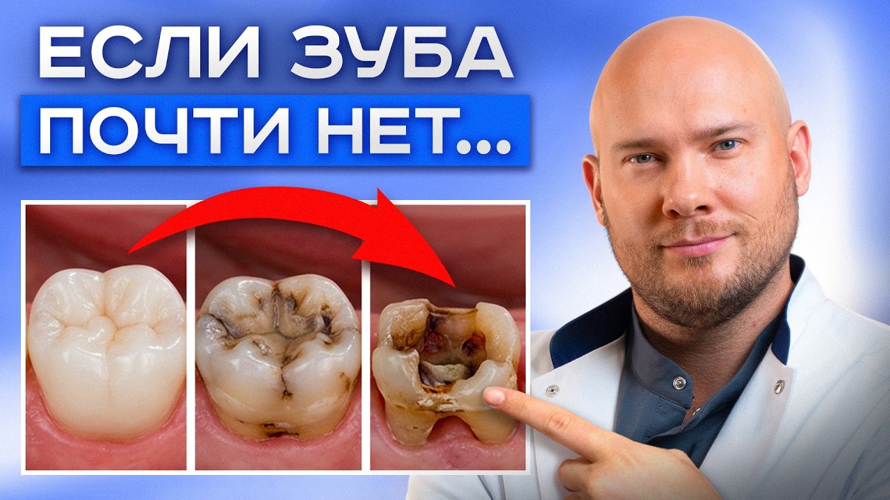 Можно ли НАРАСТИТЬ зуб на корень? Лечение зубов