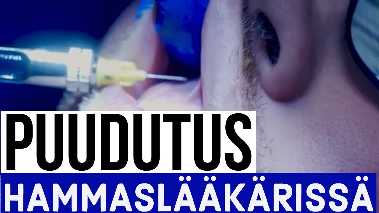 Puuduttaminen hammashoidossa - Hammaslääkäri kertoo