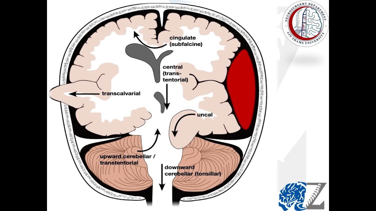 Intracranial Pressure (5):  Herniation Syndromes (2)  ضغط المخ