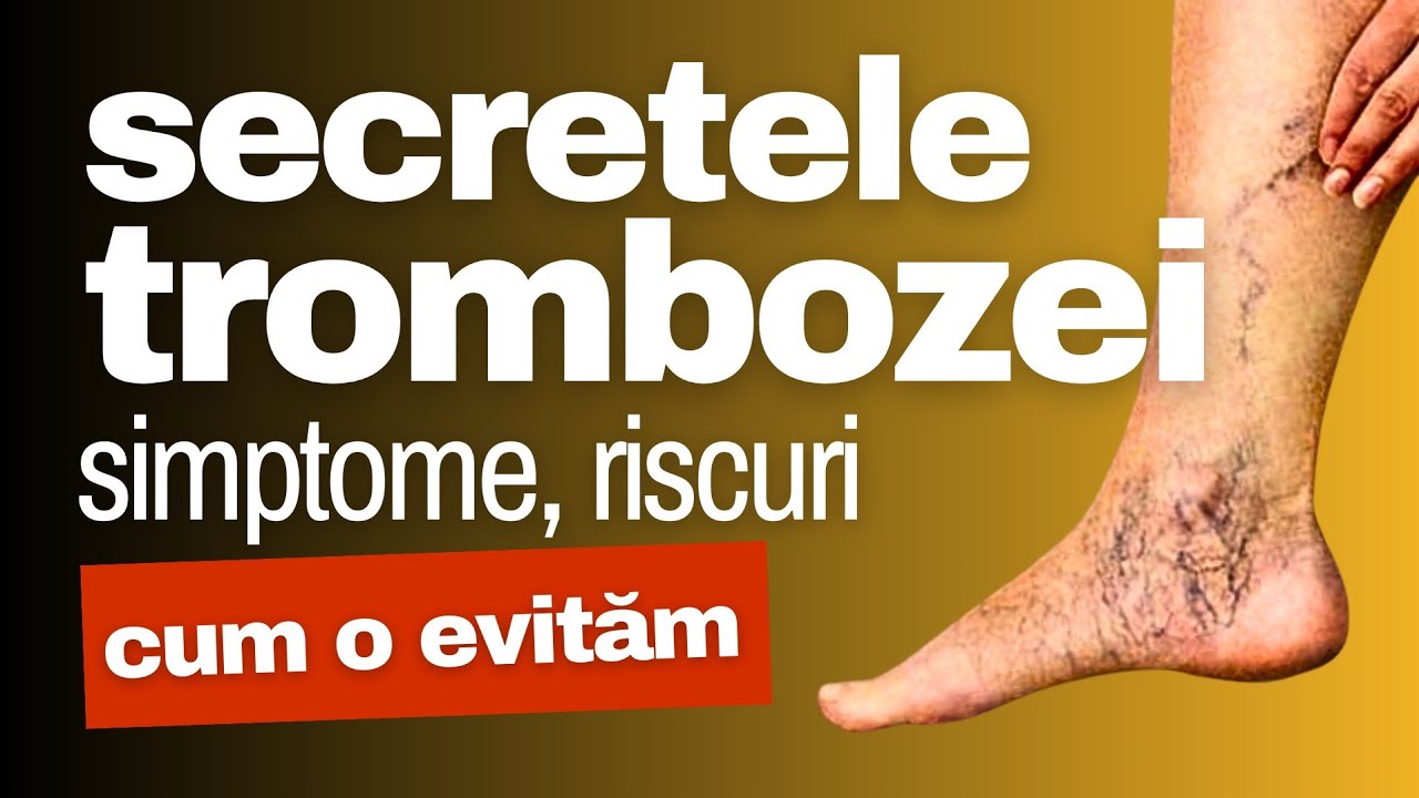 Secretele TROMBOZEI: simptome, riscuri, cum o evităm