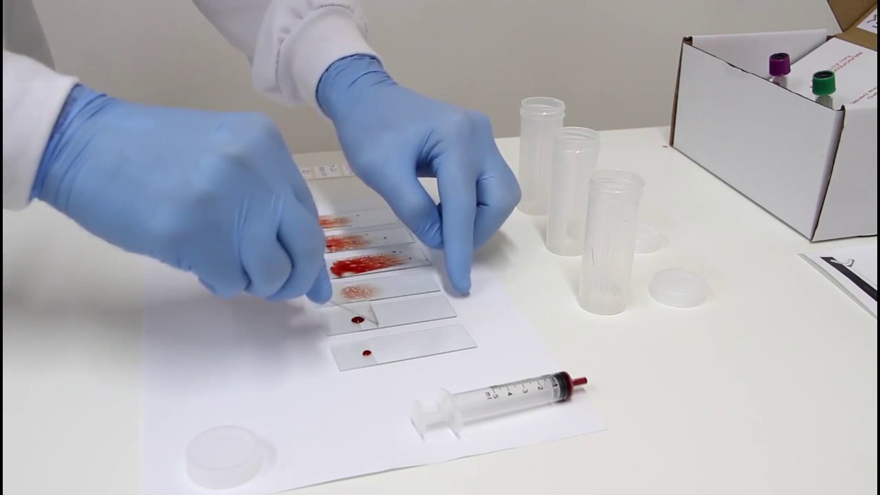 Como é realizada a técnica de esfregaço de medula óssea