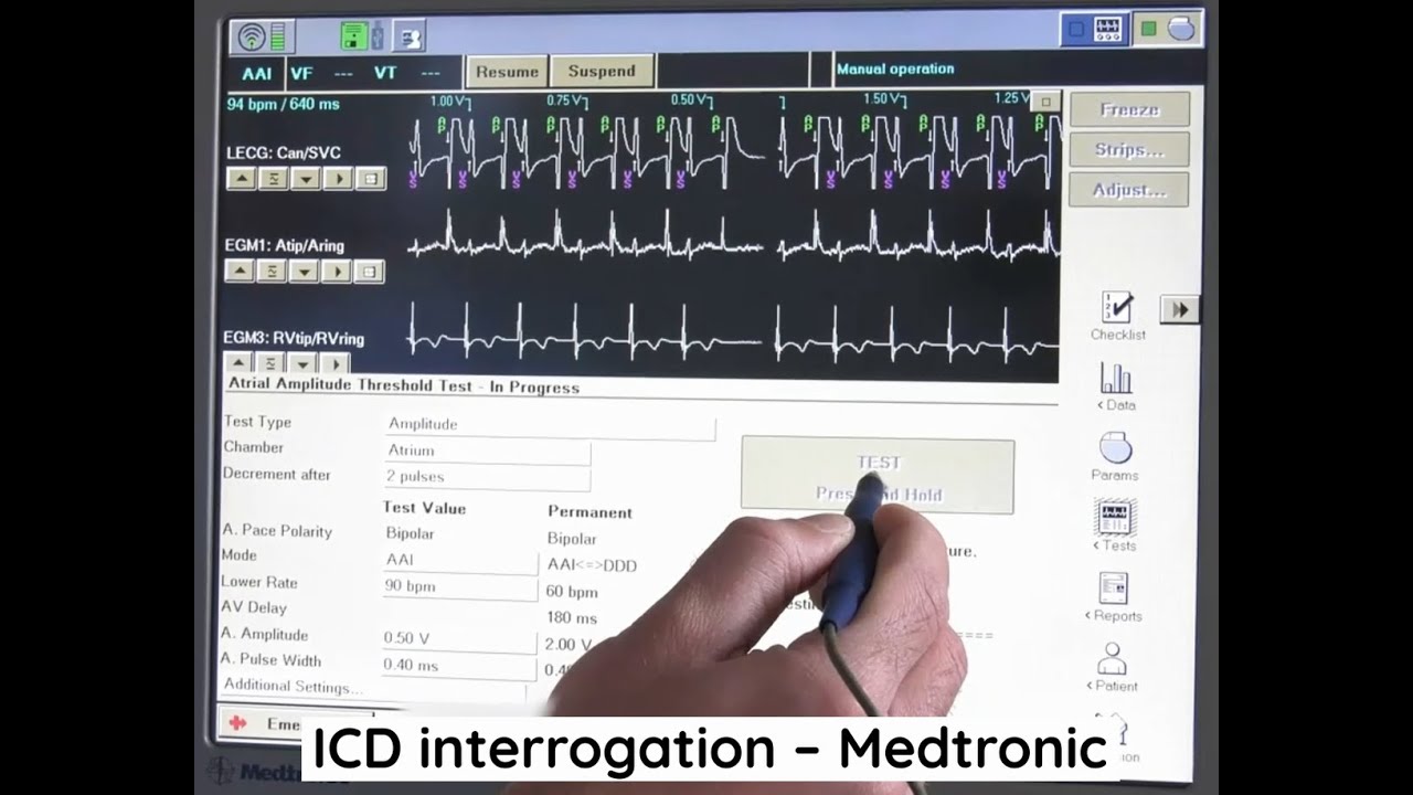 Опрос ИКД - Medtronic
