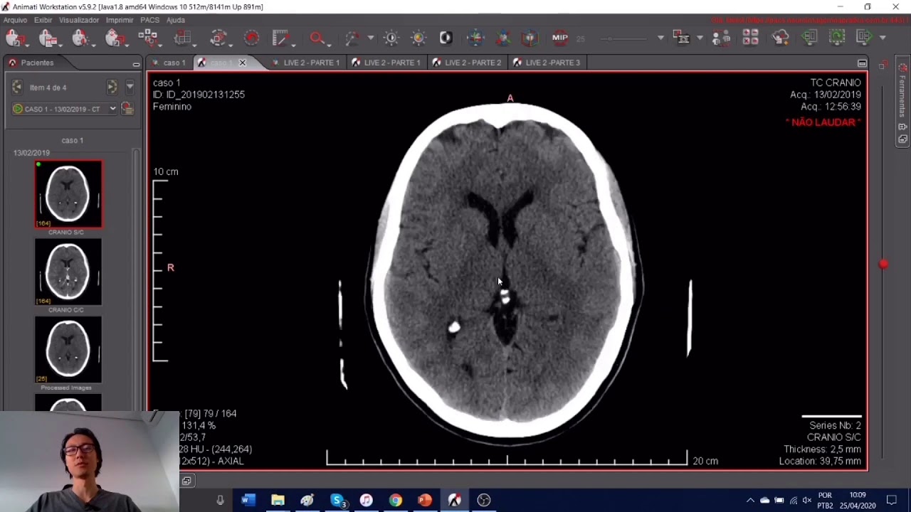Como avaliar hemorragia subaracnoide na tomografia computadorizada