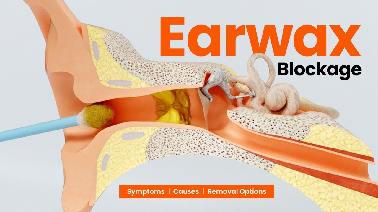 Earwax Blockage: Symptoms, Causes & Removal Options - Step by Step 3D Guide