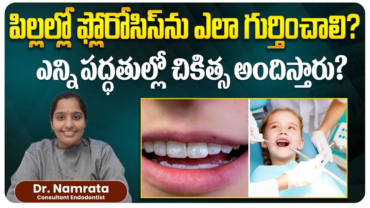 How To Identify Fluorosis In Childrens Teeth? | Dental Implant Treatment | Eledent Dental Hospitals