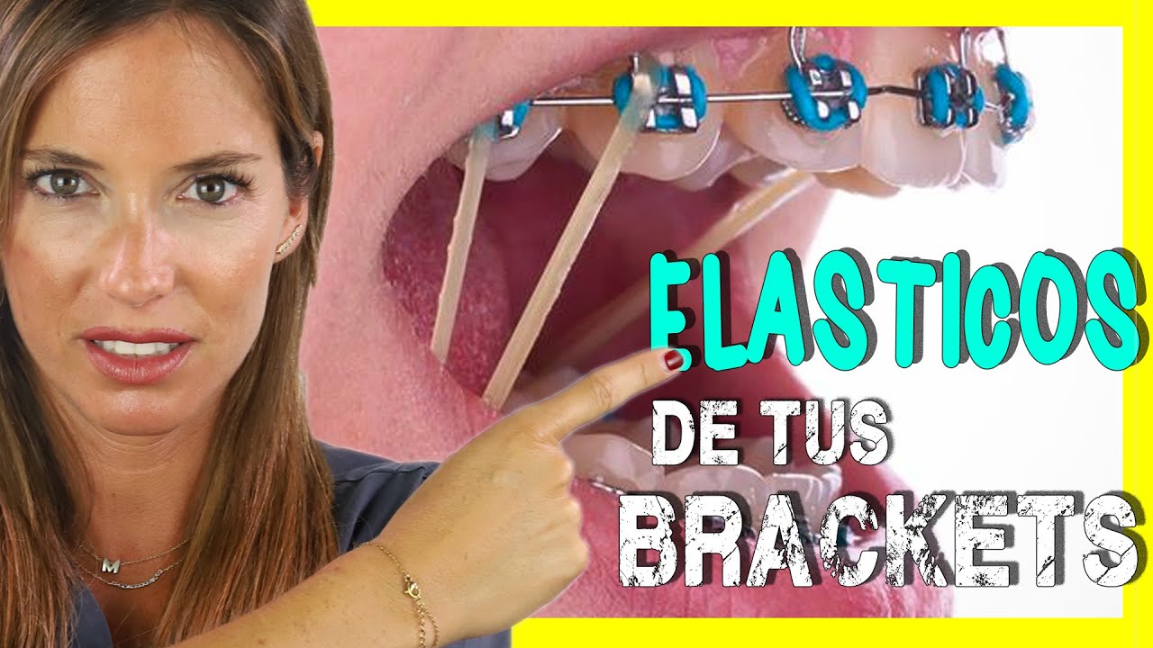 🖍📒ELASTICOS INTERMAXILARES para asentar MORDIDA - Para que sirven las GOMAS de los BRACKETS