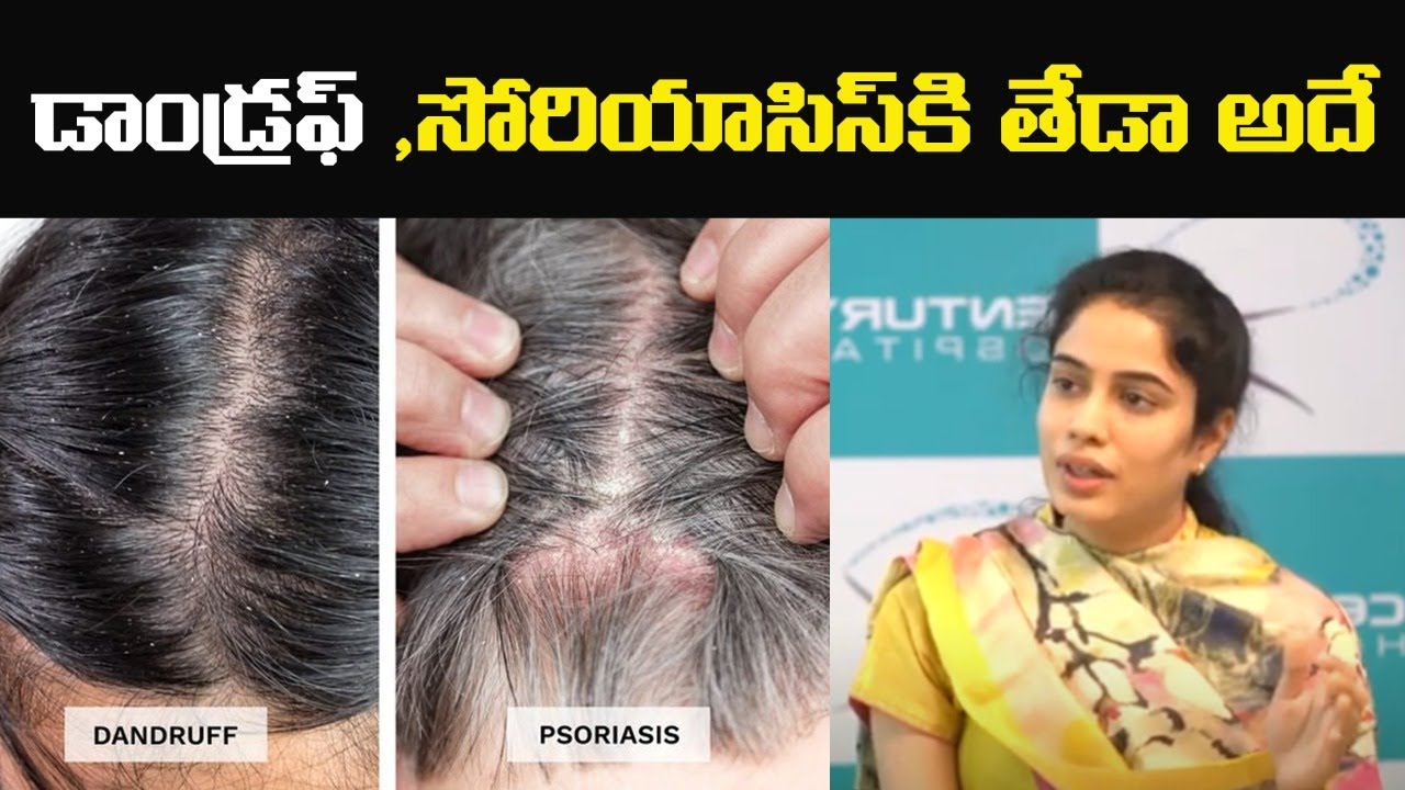 Difference Between Dandruff And Scalp Psoriasis | Hair Care Tips In Telugu | Leo Health